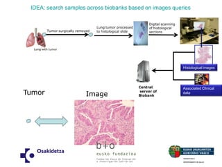 IDEA: search samples across biobanks based on images queries 
Tumor surgically removed 
Lung tumor processed 
to histological slide 
Lung with tumor 
Digital scanning of histological sections 
Central server of Biobank 
Histological images 
Associated Clinical data 
Tumor 
Image  
