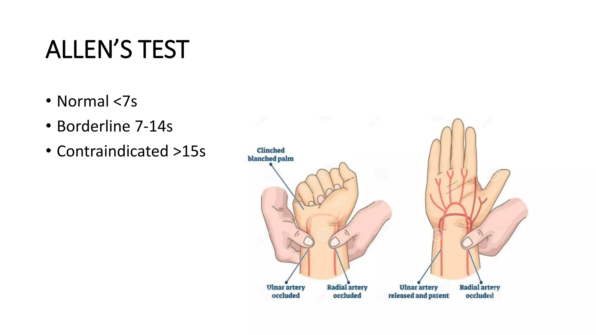 ALLEN’S TEST
• Normal <7s
• Borderline 7-14s
• Contraindicated >15s
 