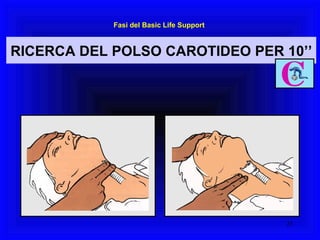 RICERCA DEL POLSO CAROTIDEO PER 10’’ Fasi del Basic Life Support 