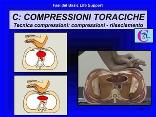 Fasi del Basic Life Support C: COMPRESSIONI TORACICHE Tecnica compressioni: compressioni - rilasciamento 