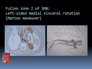 Management of injuries to great abdominal vessels. KCH, 23 Nov 10, by R ...