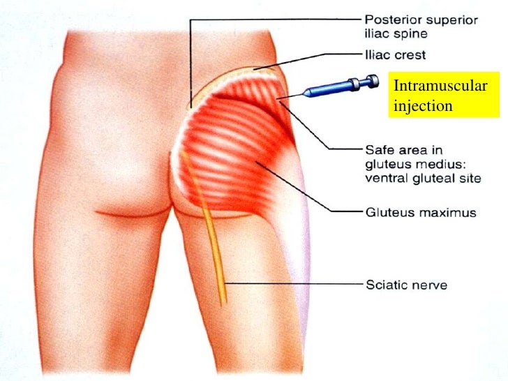 toradol injection site for back pain