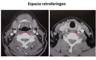 Espacio retrofaríngeo
 