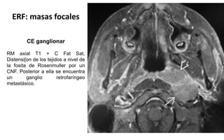 ERF: masas focales
CE ganglionar
RM axial T1 + C Fat Sat,
Distensi[on de los tejidos a nivel de
la fosita de Rosenmuller por un
CNF. Posterior a ella se encuentra
un ganglio retrofaríngeo
metastásico.
 