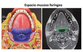 Espacio mucoso faríngeo
Pliegue
glosoepiglótico
Vallécula
Amígdala lingual
Pilar amigdalino
anterior
M. palatogloso
Amígdala palatina
Pilar amigdalino
posterior
M constrictor
faríngeo superior
EMF
E masticador
Capa media, FCP
E parafaríngeo
E retrofaríngeo
E de peligro
E carotídeo
 