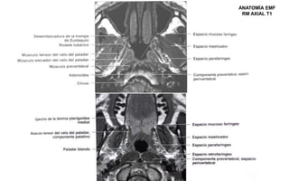 ANATOMÍA EMF
RM AXIAL T1
 