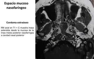Espacio mucoso
nasofaríngeo
Cordoma extraóseo
RM axial en T1 + C muestra masa
extendida desde la mucosa de la
línea media posterior nasofaríngea
a cavidad nasal posterior
 