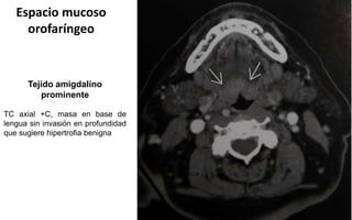 Espacio mucoso
orofaríngeo
Tejido amigdalino
prominente
TC axial +C, masa en base de
lengua sin invasión en profundidad
que sugiere hipertrofia benigna
 