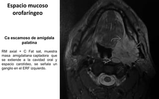 Espacio mucoso
orofaríngeo
Ca escamoso de amígdala
palatina
RM axial + C Fat sat, muestra
masa amigdaliana captadora que
se extiende a la cavidad oral y
espacio carotídeo, se señala un
ganglio en el ERF izquierdo.
 