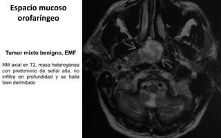 Espacio mucoso
orofaríngeo
Tumor mixto benigno, EMF
RM axial en T2, masa heterogénea
con predominio de señal alta, no
infiltra en profundidad y se halla
bien delimitado
 