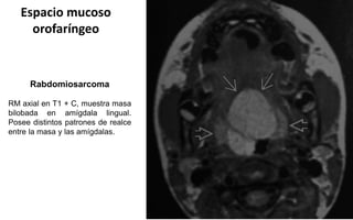 Espacio mucoso
orofaríngeo
Rabdomiosarcoma
RM axial en T1 + C, muestra masa
bilobada en amígdala lingual.
Posee distintos patrones de realce
entre la masa y las amígdalas.
 