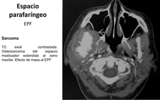 Espacio
parafaríngeo
EPF
Sarcoma
TC axial contrastada.
Osteosarcoma del espacio
masticador extendida al seno
maxilar. Efecto de masa al EPF
 