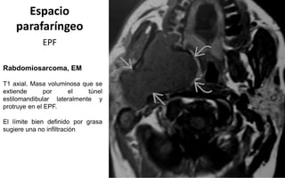 Espacio
parafaríngeo
EPF
Rabdomiosarcoma, EM
T1 axial. Masa voluminosa que se
extiende por el túnel
estilomandibular lateralmente y
protruye en el EPF.
El límite bien definido por grasa
sugiere una no infiltración
 