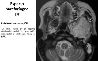 Espacio
parafaríngeo
EPF
Rabdomiosarcoma, EM
T2 axial. Masa en el espacio
masticador medial con destrucción
mandibular e infiltración hacia el
EPF.
 