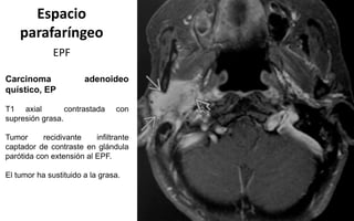Espacio
parafaríngeo
EPF
Carcinoma adenoideo
quístico, EP
T1 axial contrastada con
supresión grasa.
Tumor recidivante infiltrante
captador de contraste en glándula
parótida con extensión al EPF.
El tumor ha sustituido a la grasa.
 