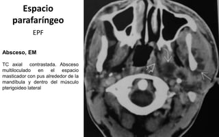 Espacio
parafaríngeo
EPF
Absceso, EM
TC axial contrastada. Absceso
multiloculado en el espacio
masticador con pus alrededor de la
mandíbula y dentro del músculo
pterigoideo lateral
 