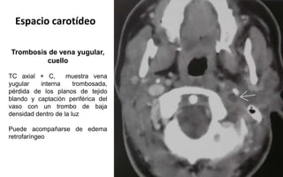 Espacio carotídeo
Trombosis de vena yugular,
cuello
TC axial + C, muestra vena
yugular interna trombosada,
pérdida de los planos de tejido
blando y captación periférica del
vaso con un trombo de baja
densidad dentro de la luz
Puede acompañarse de edema
retrofaríngeo
 
