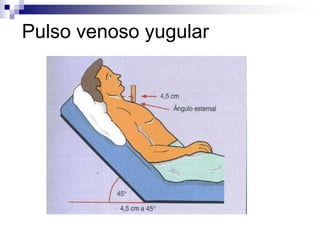 Valoración CardiovascularValorar las venas yugulares. Permiten Estimar el volumen intravascular.observar latido del ápex. Como consecuencia de la contracción del ventrículo izquierdo.  Se localiza en 5 espacio intercostal izquierdo sobre la línea media clavicular. Pulso normal visible en la pared torácica. 
