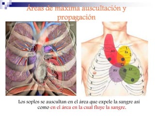 Levantamentos (impulso sistólico)