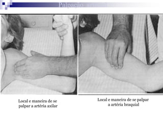 Valoración Cardiovascular Medición de la presión arterial.Se mide en ambos brazos para descartar normalidades. Normalmente la PA entre ambos brazos sólo varia en 5-10mm Hg. Una diferencia de 20mm Hg o mayor sugiere compresión arterial u obstrucción en el lado en que la PA es menor.