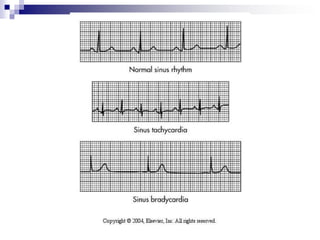 Cuidados de Enfermería en la medición de la Presión Arterial.Tomar en cuenta los elementos para la medición de una PA….Cuando es monitorizada por vía invasiva, van dirigidas al cuidado y mantenimiento del sistema. 