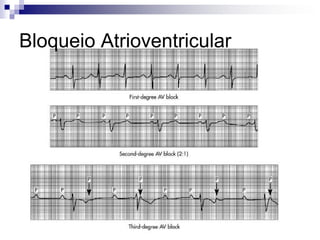  Señala la cantidad de presión   ejercida por la cámara de goma   sobre el brazo y por ende sobre    la arteria que está debajo. Señala el desplazamiento   libre del mercurio por un tubo de   vidrio limpio Los números y la escala    deben estar bien demarcadosMANOMETRO DE MERCURIO