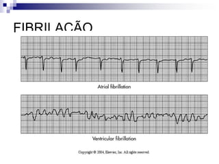 Por canulación intra-arterial.Esfigmomanómetro aneroide