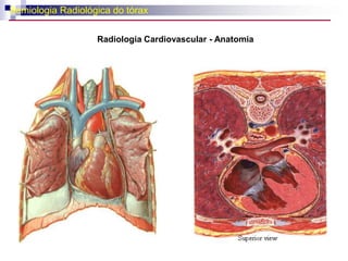Semiologia Radiológica do tóraxRadiologia Cardiovascular - Anatomia