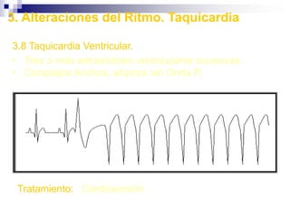 Pulso AlternanteAlternante entre amplitud pequeña y grandeFallo ventricular izq