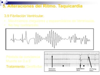 Pulso BigeminalContraccion normal, seguido de contraccion prematuraArritmias