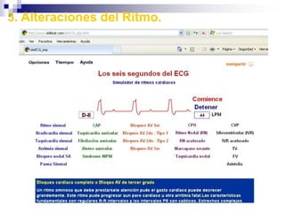 Pulso ParadojicoExagerada disminucion en la amplitud del pulso durante la inspiracion, Asma, enfisema, derrame pericardico, pericarditis constrictiva