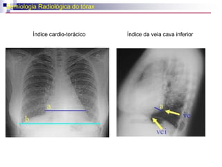 Murmullo vena yugularHUM venosoCara medial de la art esterno clavicular, cara anterior del ECMEn adultos se puede escuchar en anemia, embarazo, tirotoxicosis