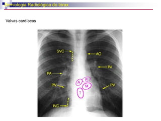 A- Localização normal do ictus cordis,B- Hipertrofia ventricular direita – levantamento da região precordial, próximo ao  esterno, não corresponde ao ictus,C- Hipertrofia ventricular esquerda sem dilatação – deslocamento mínimo ictus ou não aparece,D- Hipertrofia e dilatação ventricular esquerda – ictus desviado para baixo e fora mais amplo.
