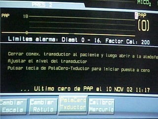 TAQUIARDIA PAROXISMICA