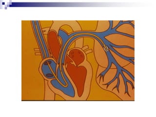 PP2. Alteraciones del Ritmo: Bradicardiab) Bloqueo de Segundo Grado: Mobitz I (Wenckebach)   P R se va alargando antes del complejo.