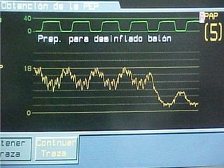    Hasta que post onda P no hay complejo.