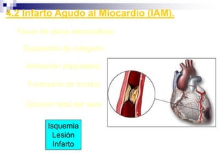  Peligroso: Persiste o muy rápido.3. Alteraciones del Ritmo. Taquicardia2.2 Taquicardia por Reentrada: (WPW)   Impulso del NS Normal.