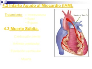    Ondas P no son claramente visibles.