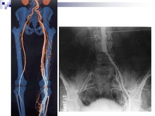    Se instala y desaparece bruscamente.