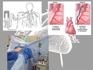   Si es muy frecuente Tratamiento farmacológico.3. Alteraciones del Ritmo. Taquicardia3.5 Flütter Auricular: Aleteo auricular   Aurículas se contraen a mayor frec.