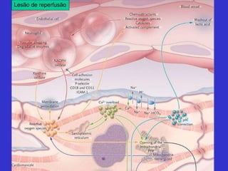 Lesão de reperfusão 
 