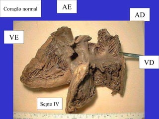 Coração normal 
AD 
AE 
VE 
VD 
Septo IV 
 