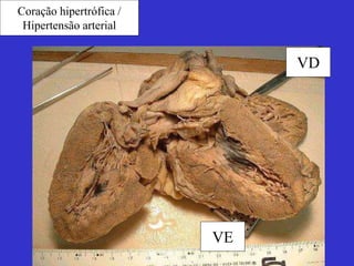 Coração hipertrófica / 
Hipertensão arterial 
VE 
VD 
 
