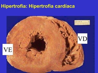 Hipertrofia: Hipertrofia cardíaca 
VD 
VE 
 