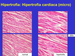 Hipertrofia: Hipertrofia cardíaca (micro) 
normal hipertrofia 
200x 
 