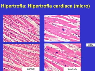Hipertrofia: Hipertrofia cardíaca (micro) 
normal hipertrofia 
400x 
 