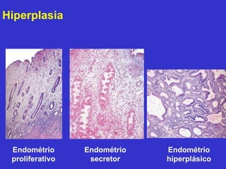 Endométrio 
proliferativo 
Endométrio 
secretor 
Endométrio 
hiperplásico 
Hiperplasia 
 