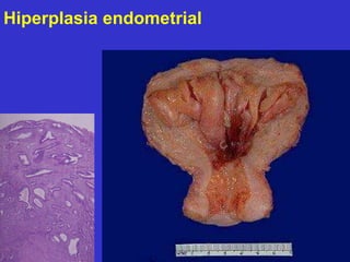 Hiperplasia endometrial 
 