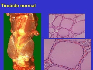 Tireóide normal 
 