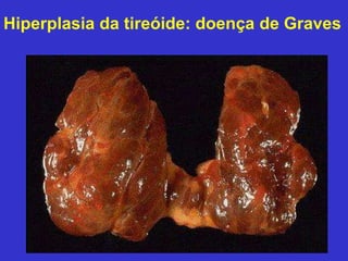Hiperplasia da tireóide: doença de Graves 
 